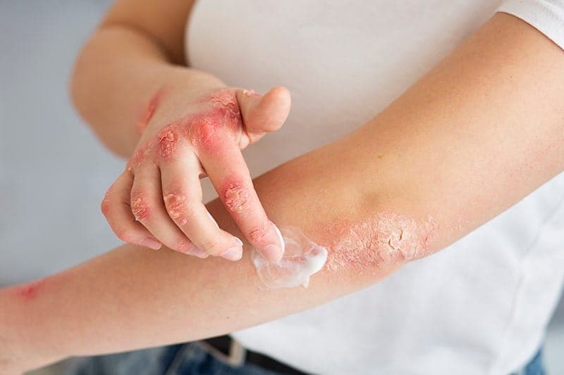 Bỏng và viêm da